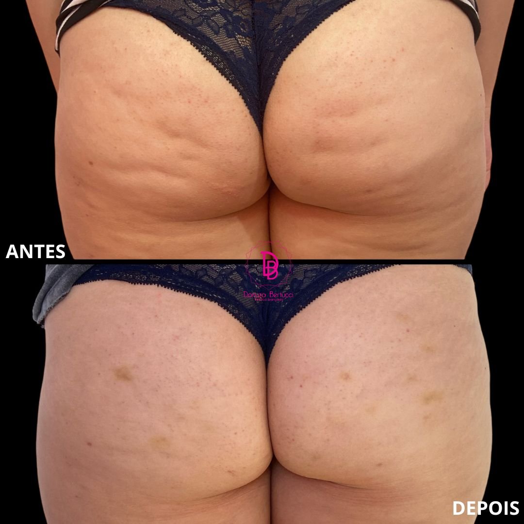 Bioestimulador de Colágeno