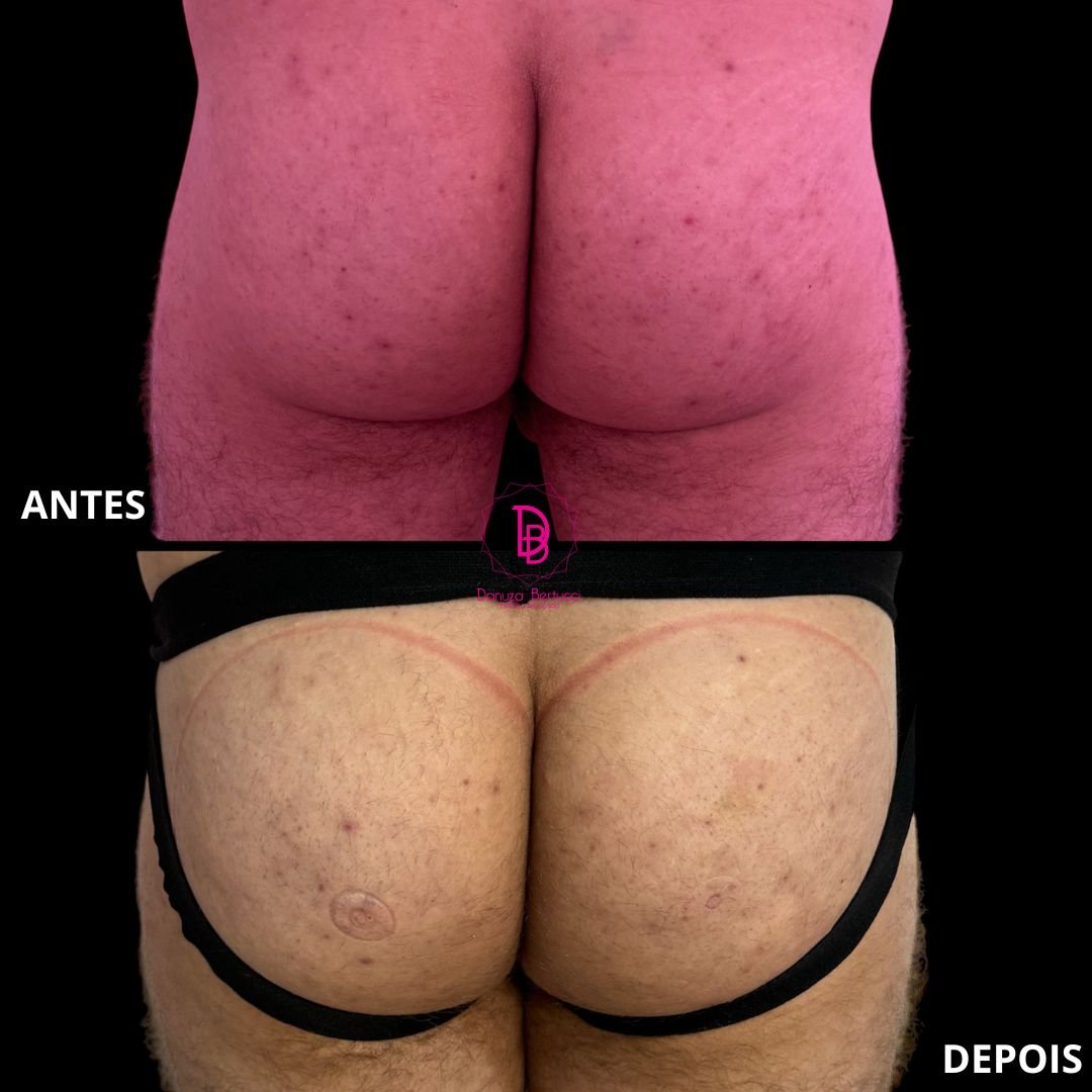 Bioestimulador de Colágeno (2)