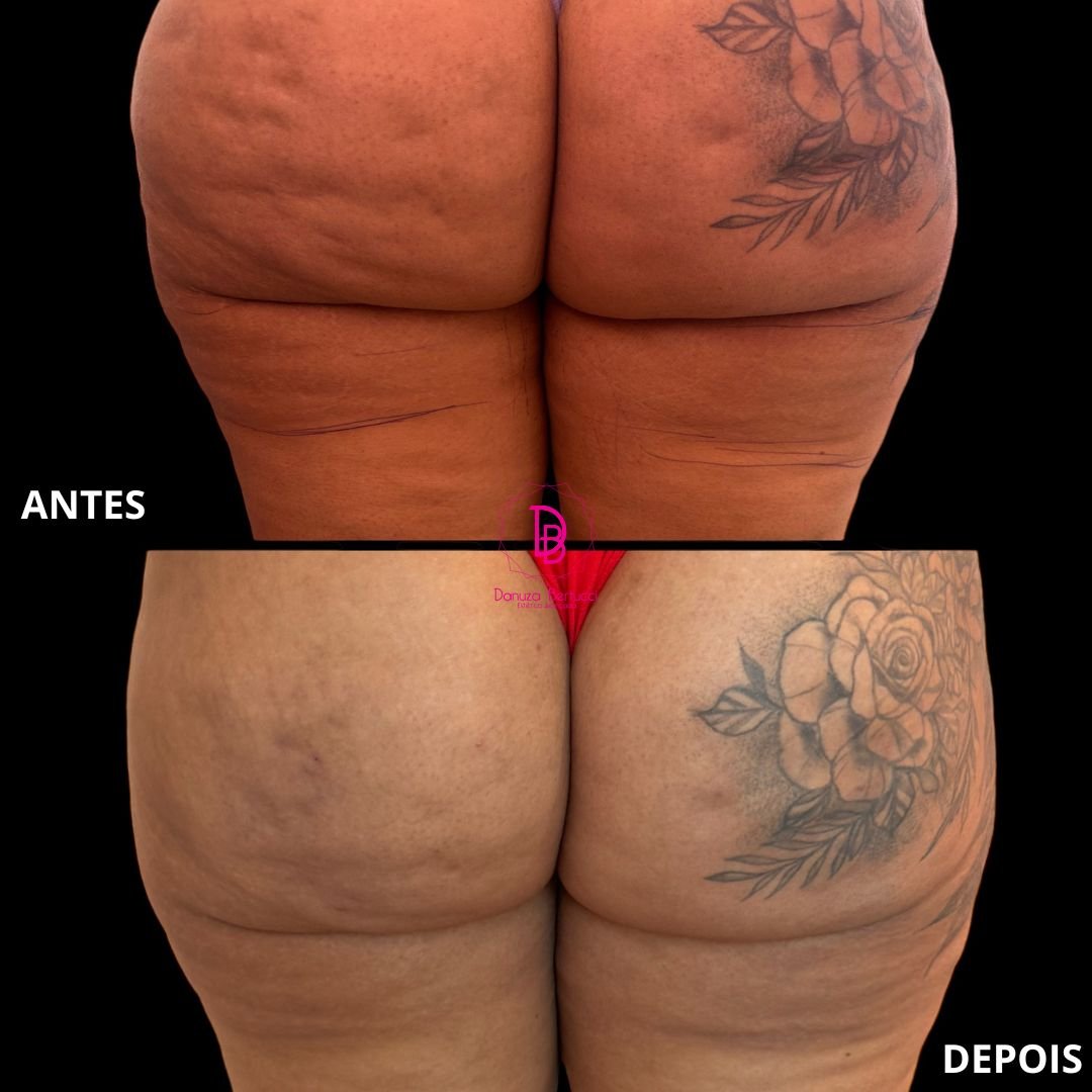 Bioestimulador de Colágeno (3)