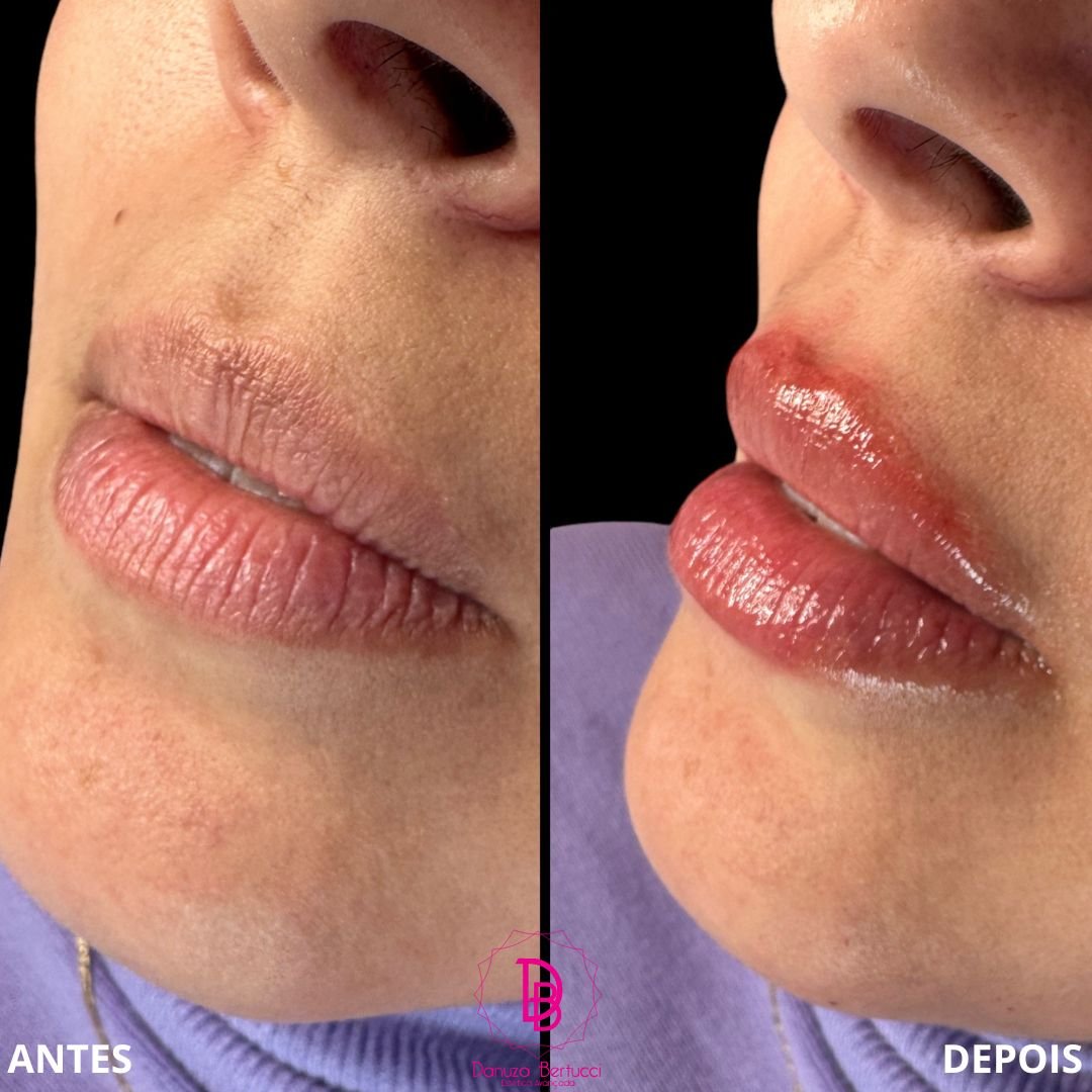 Preenchimento Labial