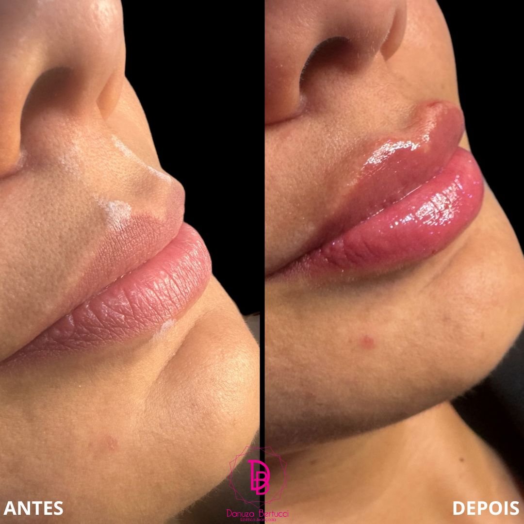 Preenchimento Labial (10)