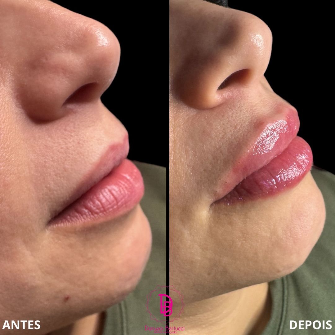 Preenchimento Labial (11)