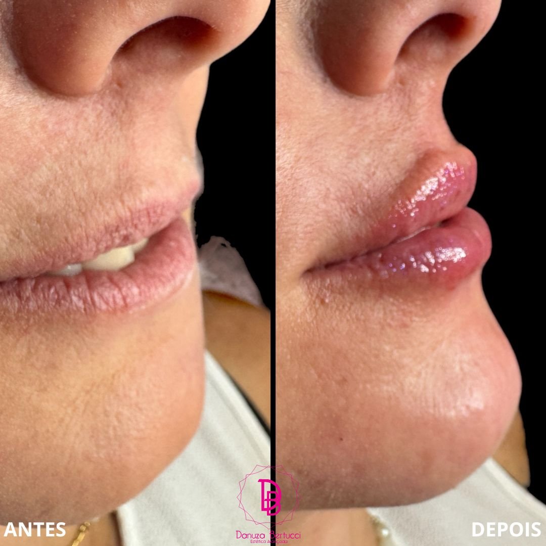 Preenchimento Labial (12)