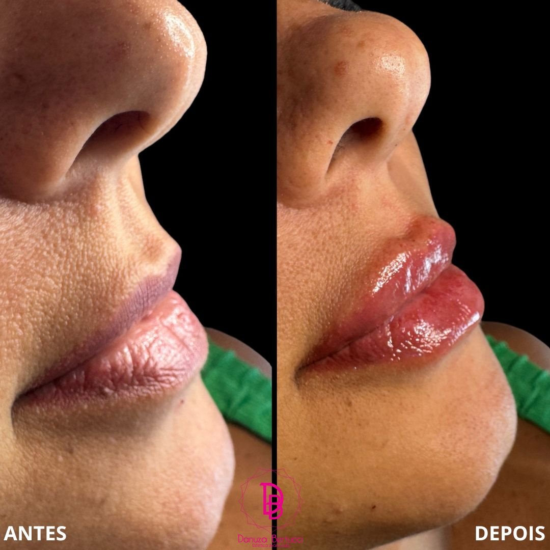 Preenchimento Labial (2)