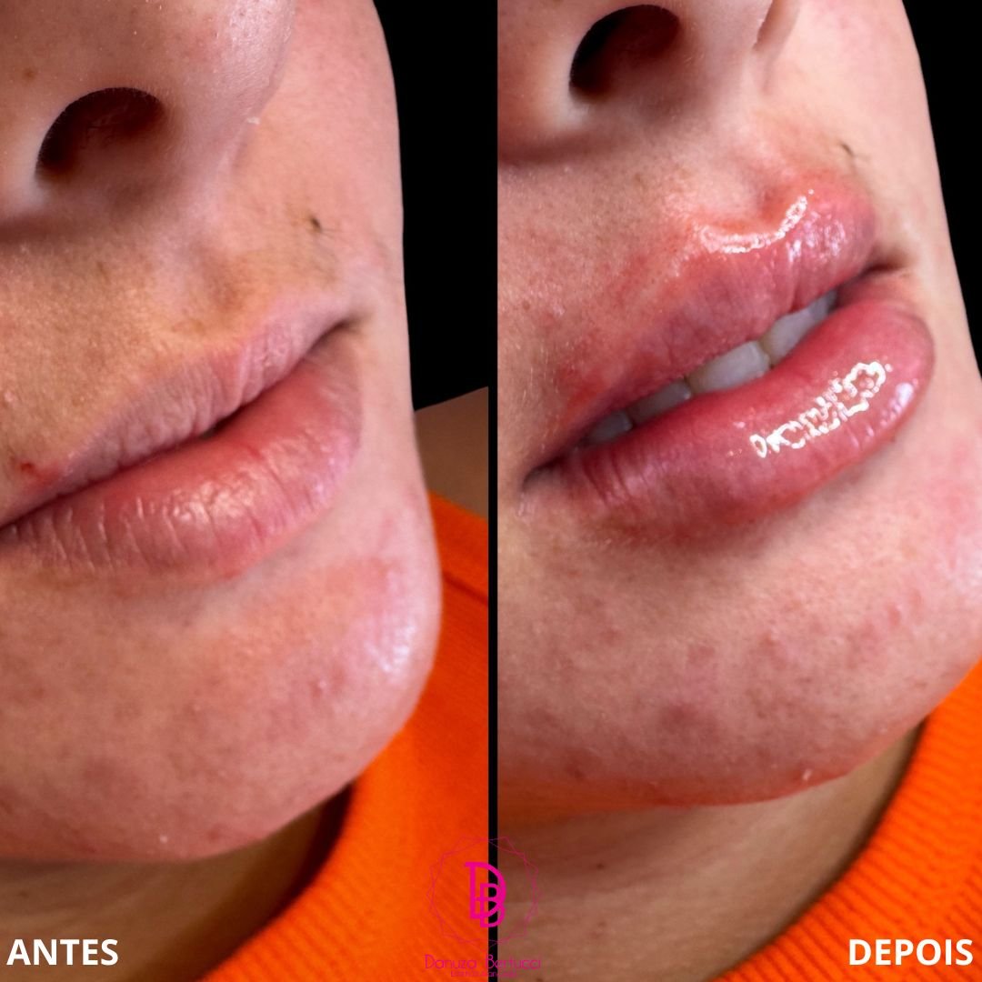 Preenchimento Labial (3)