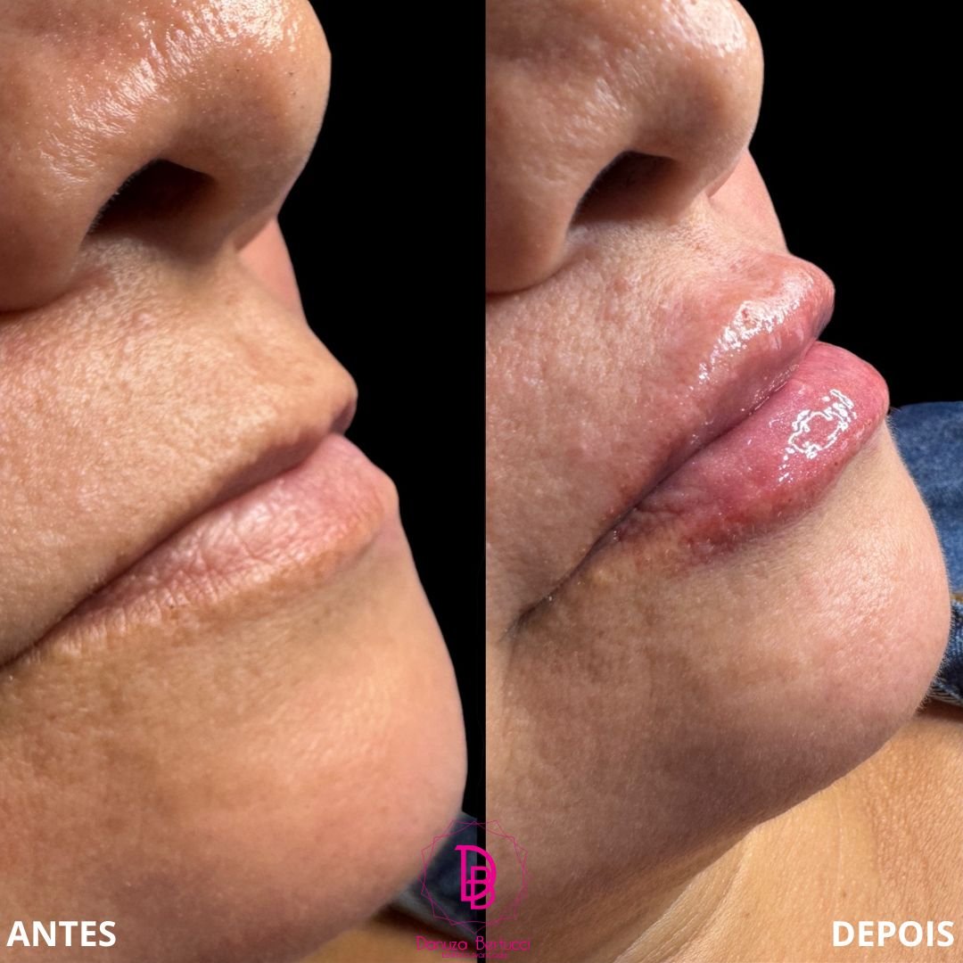 Preenchimento Labial (4)