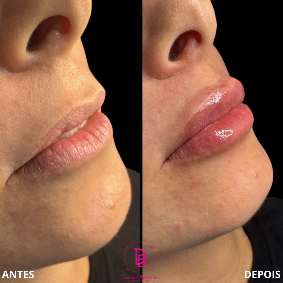 Preenchimento Labial (5)