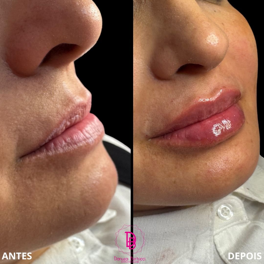 Preenchimento Labial (6)