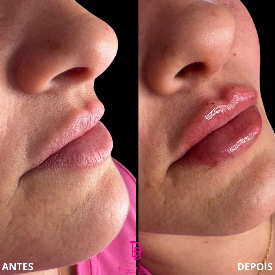 Preenchimento Labial (7)