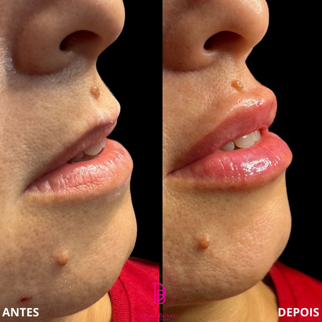 Preenchimento Labial (8)