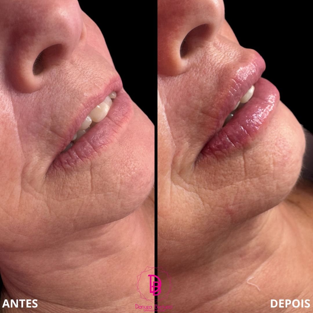 Preenchimento Labial (9)