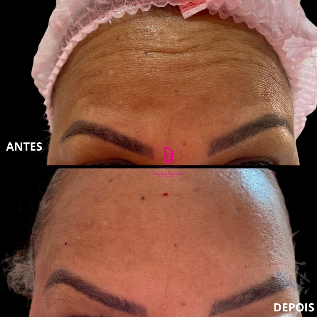 Toxina Botulínica (2)