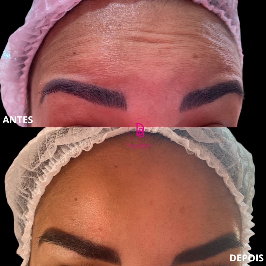 Toxina Botulínica (3)