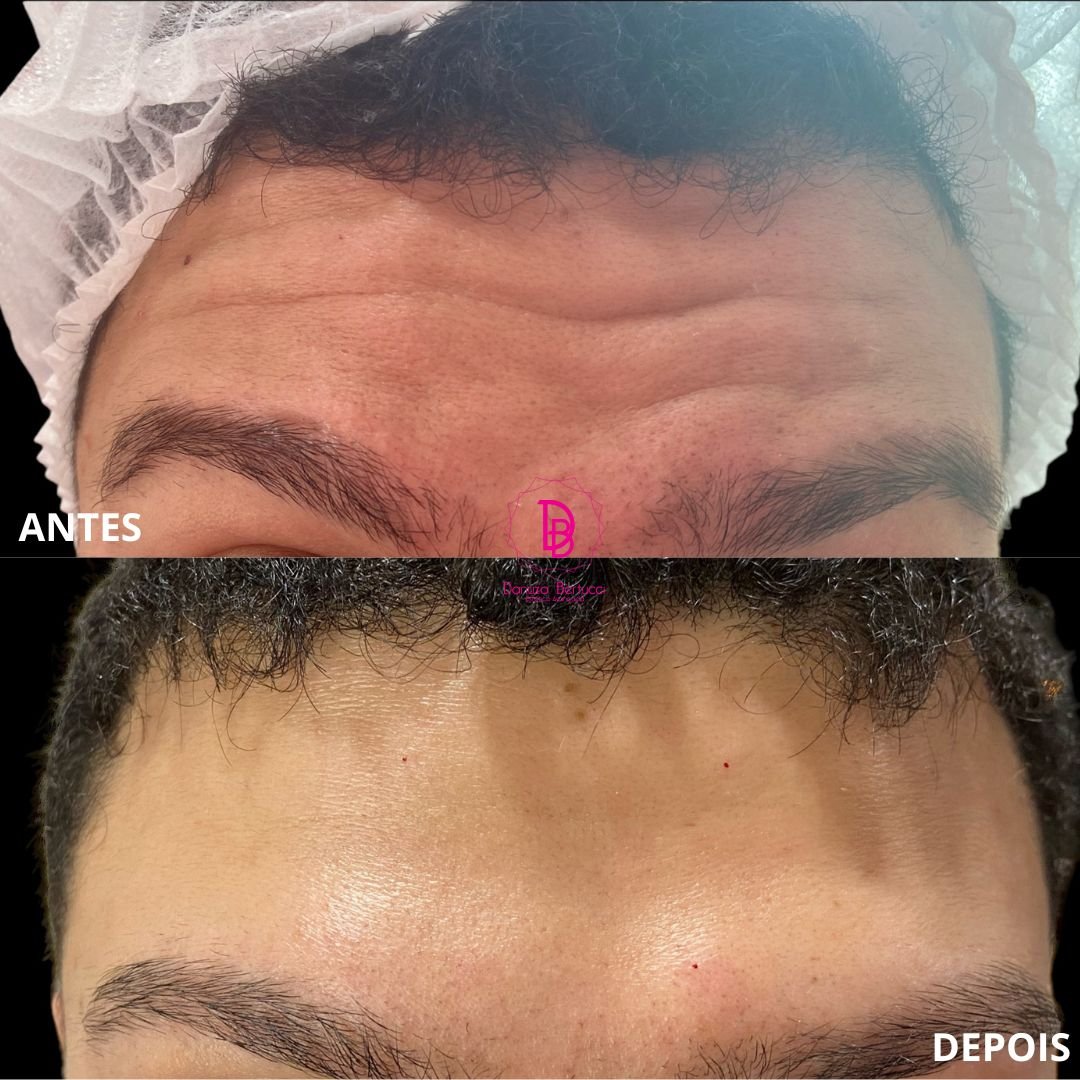 Toxina Botulínica (4)