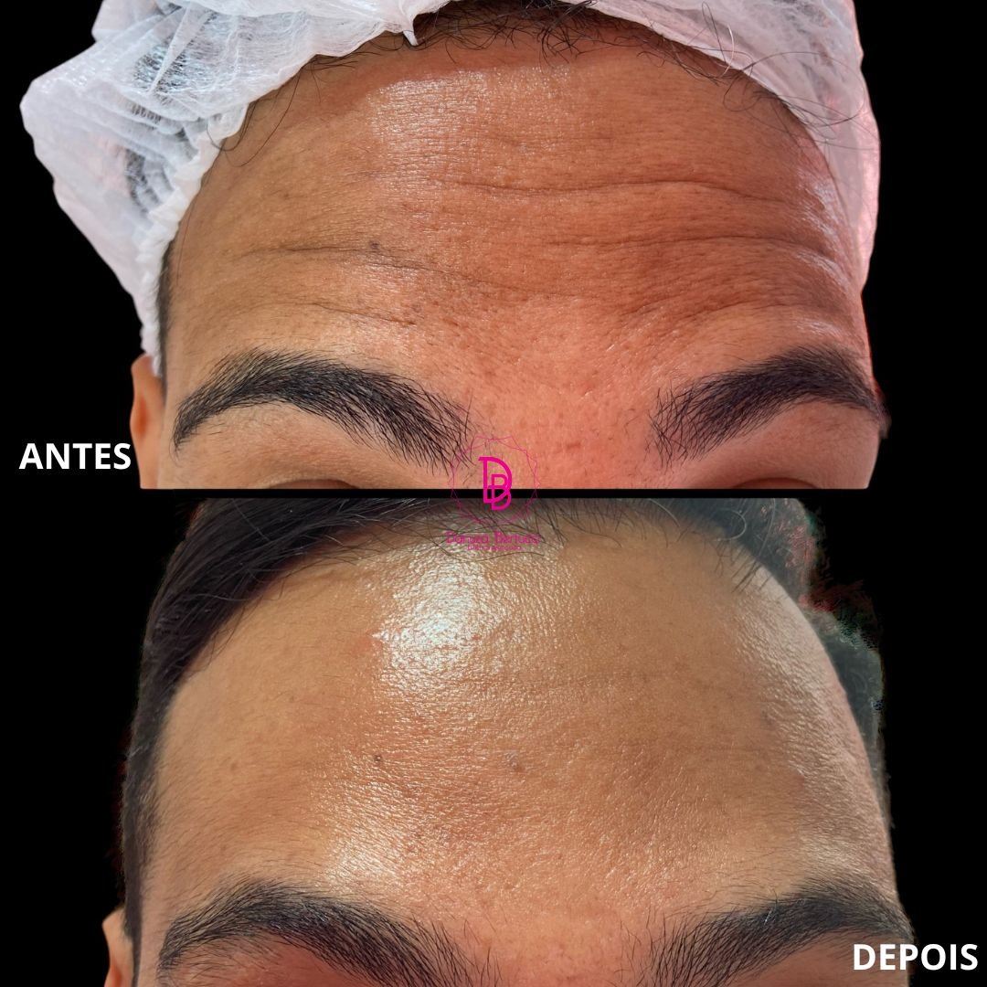 Toxina Botulínica (5)