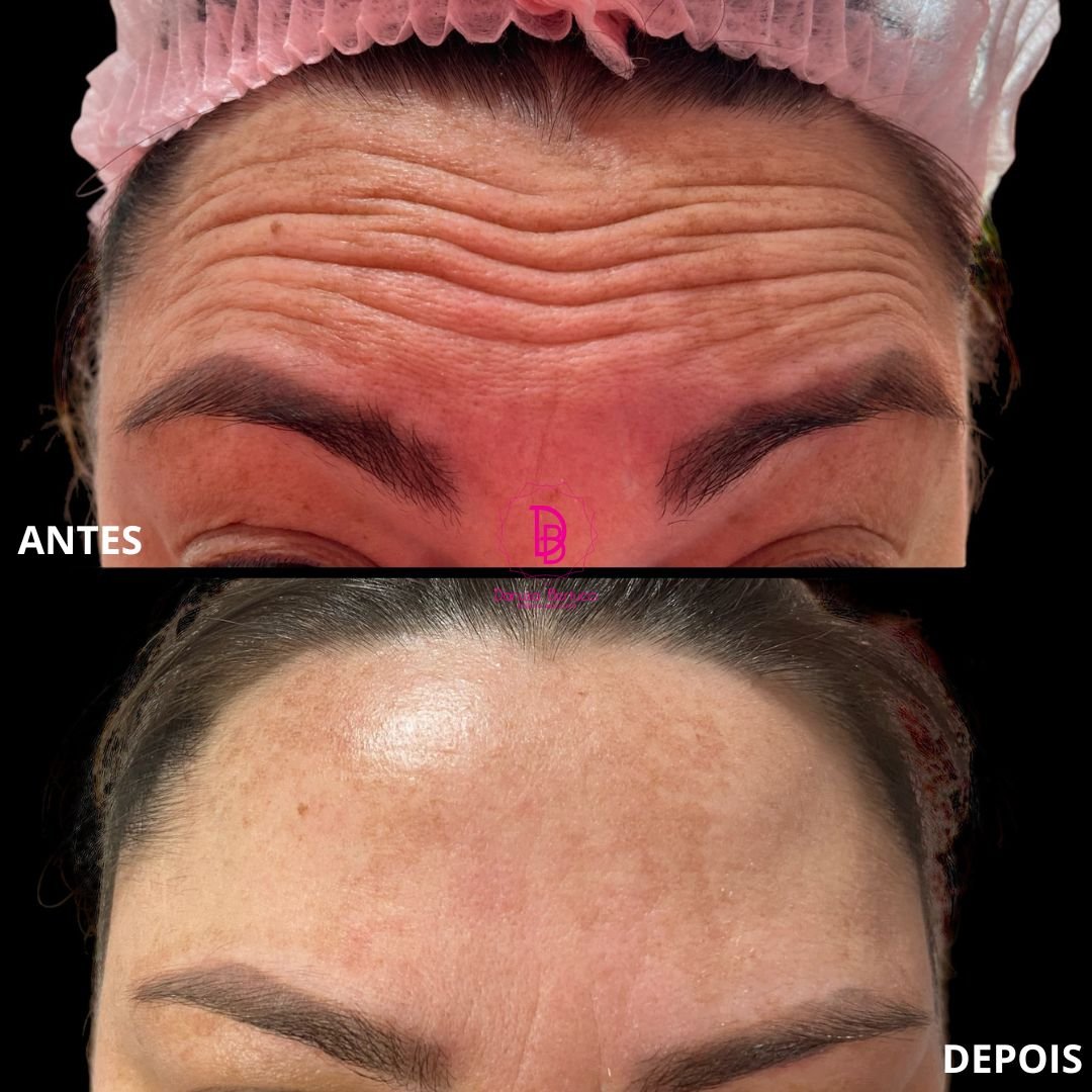 Toxina Botulínica (6)