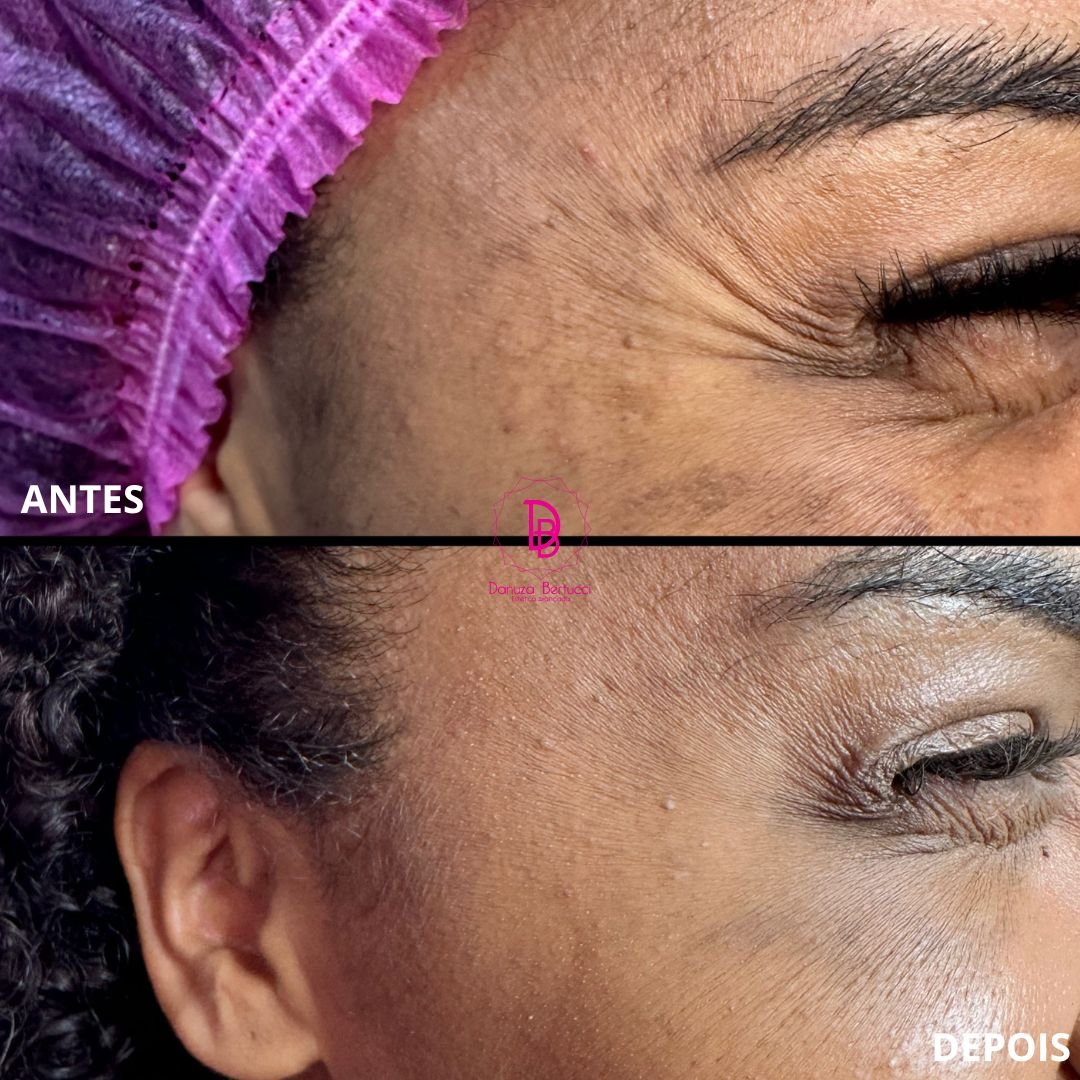 Toxina Botulínica (7)