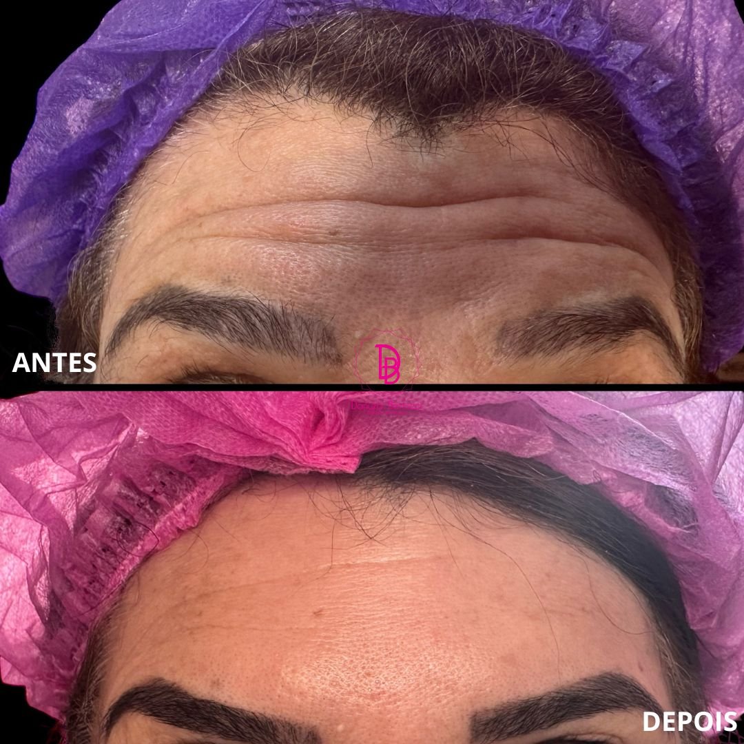 Toxina Botulínica (8)